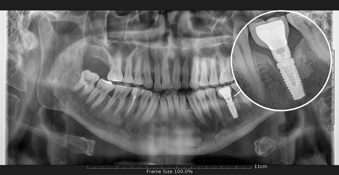 Tooth and dental implant X-ray